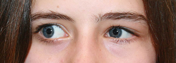 Augen unterschiedlich große Unterschiedlich große